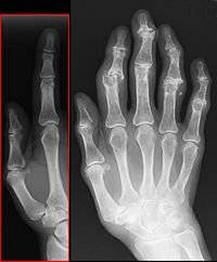 9 raisons prédisposant à l’arthrite du genou