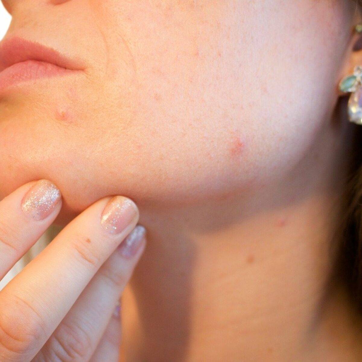 Récess à l’acné : adoucissant l’acné naturelle